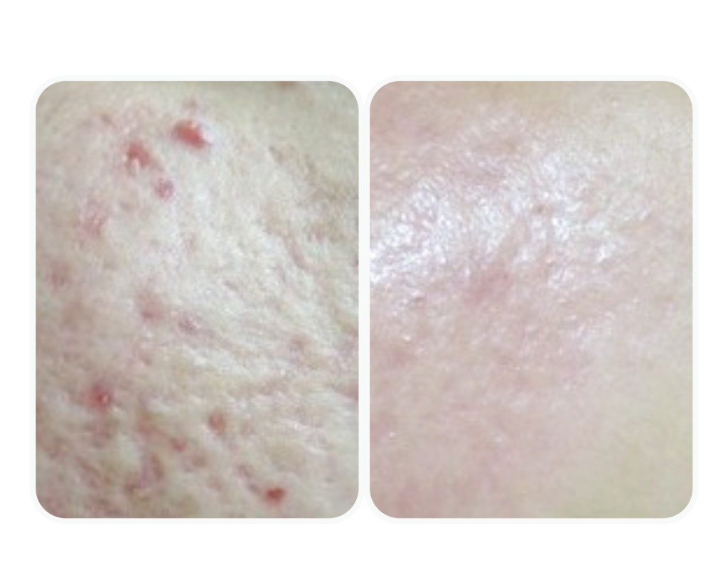 blizna potrądzikowa efekt przed i po - laseroterapia - Chirurgia Bednarska